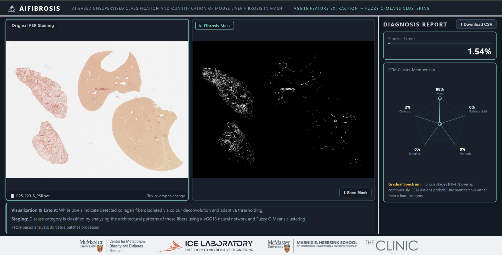 AI liver fibrosis clinical tool preview